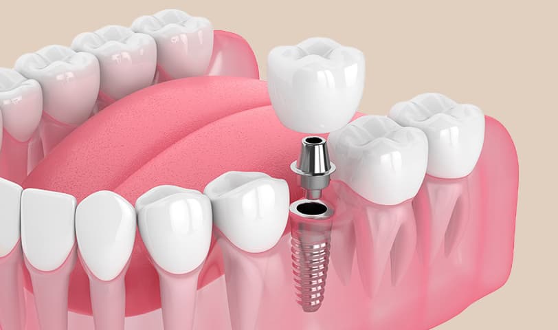 Ilustración de un implante dental de titanio con su corona sobre la encía