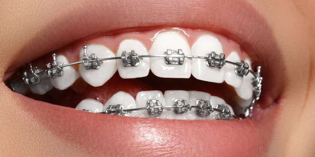 Primer plano de una sonrisa con brackets metálicos de ortodoncia